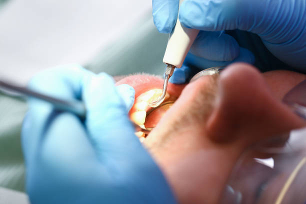 Best Emergency Dental Extractions in Pearland, TX